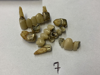 Posten "Zahngold, teilweise mit Zähnen": Gold mit etwas Zahn: 26g, Gold mit sehr viel Zahn 56,2g, Zähne mit Metall 68,3g